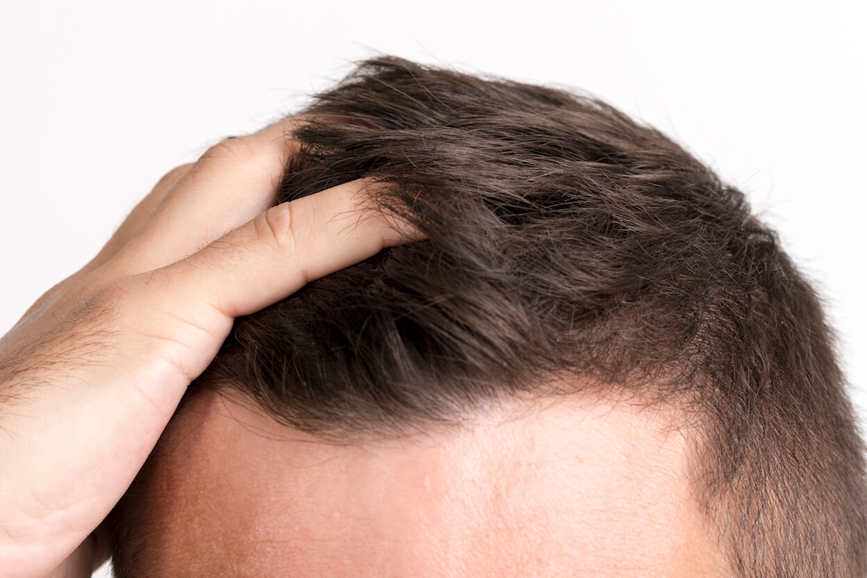 Limitations of Donor Hair That Can Be Used in Hair Transplants