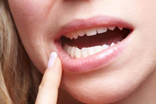 Overcome the pain of carrying an aching wisdom tooth